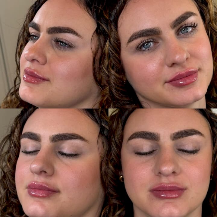 After Lip Injections
