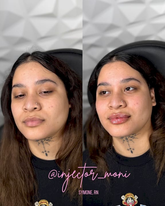 Find the best lip filler for natural, fuller lips