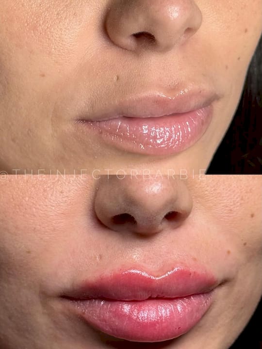 restylane fillers