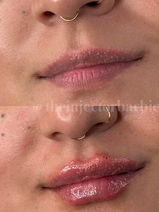 lip fillers before after Texas
