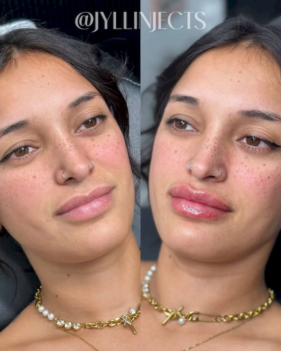 Qué hacen los rellenos labiales: ventajas, riesgos y resultados