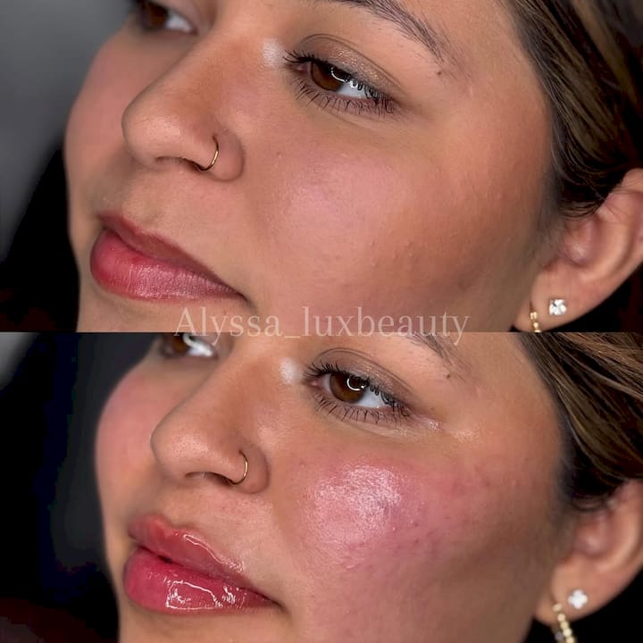 Juvederm Ultra frente a Voluma: ¿qué relleno es el adecuado para ti?