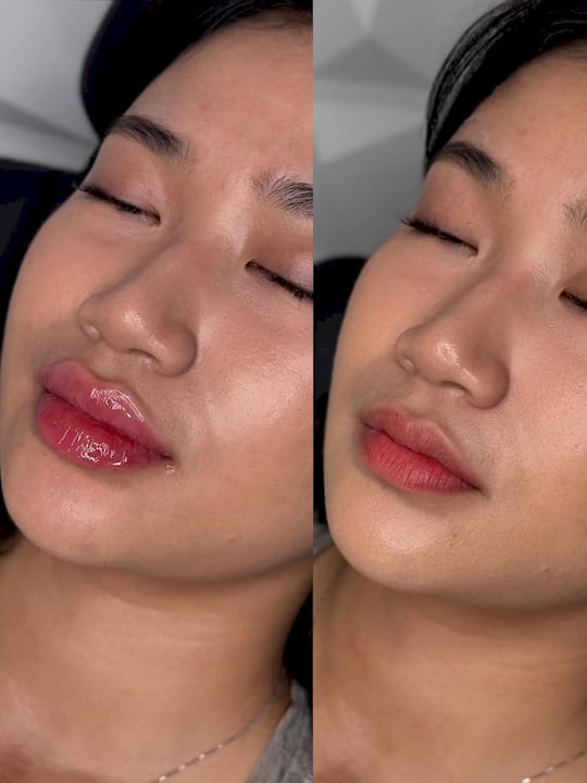 What Is RHA Filler? Your Guide to Resilient HA