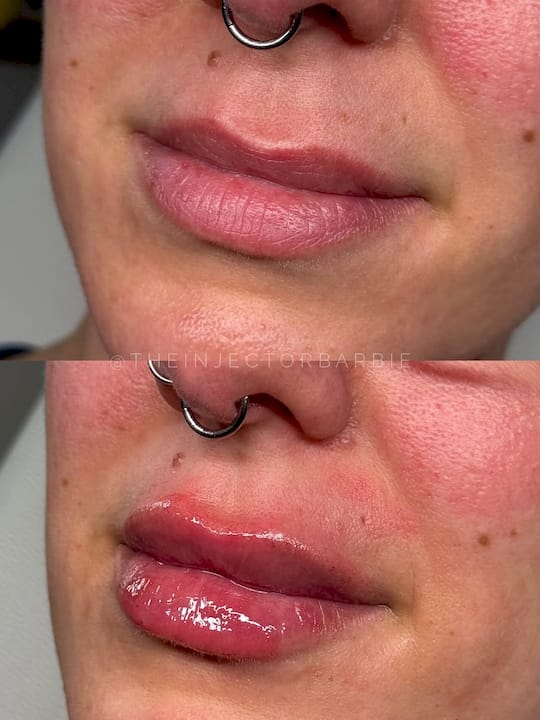 How Long Do Lip Fillers Last? Your Complete Guide