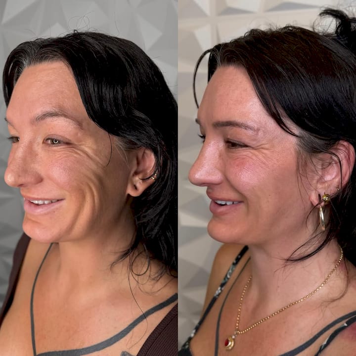 How to Get Rid of Fine Lines Around the Mouth Naturally