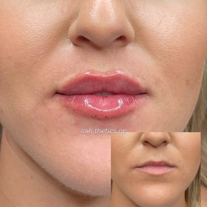 Juvederm Ultra XC for Lips and Lines: What to Know