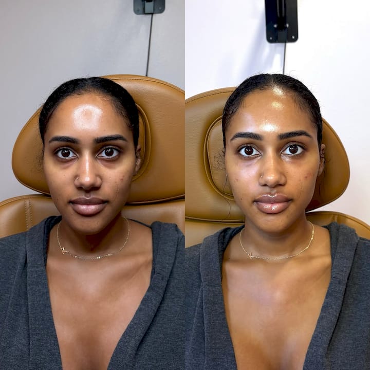 Non Surgery Face Lift: Options, Results, and How to Choose