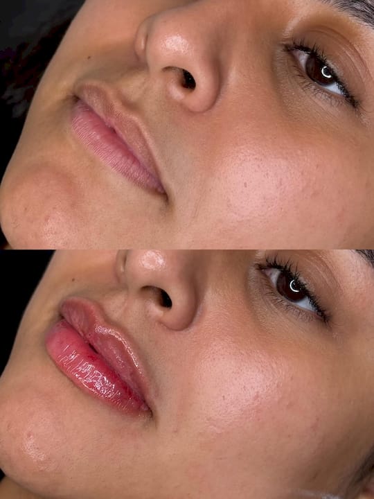 Hyaluronic Acid Filler: What the Hyaluron Pen Term Really Means