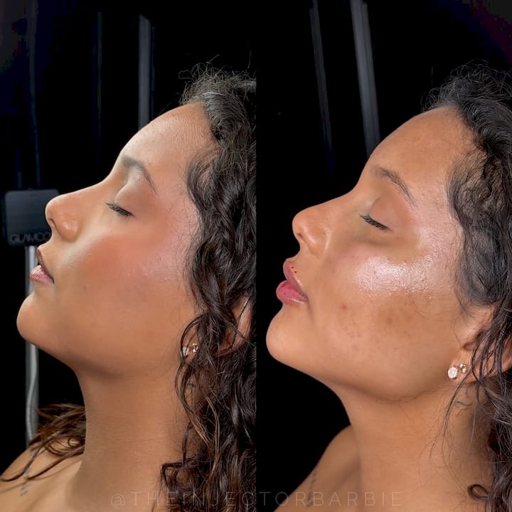 Kybella for Double Chin: What It's Used For
