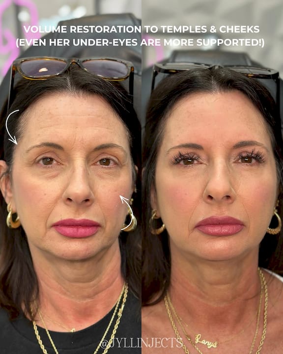 Sculptra for Smile Lines: Results, Timeline, and Cost