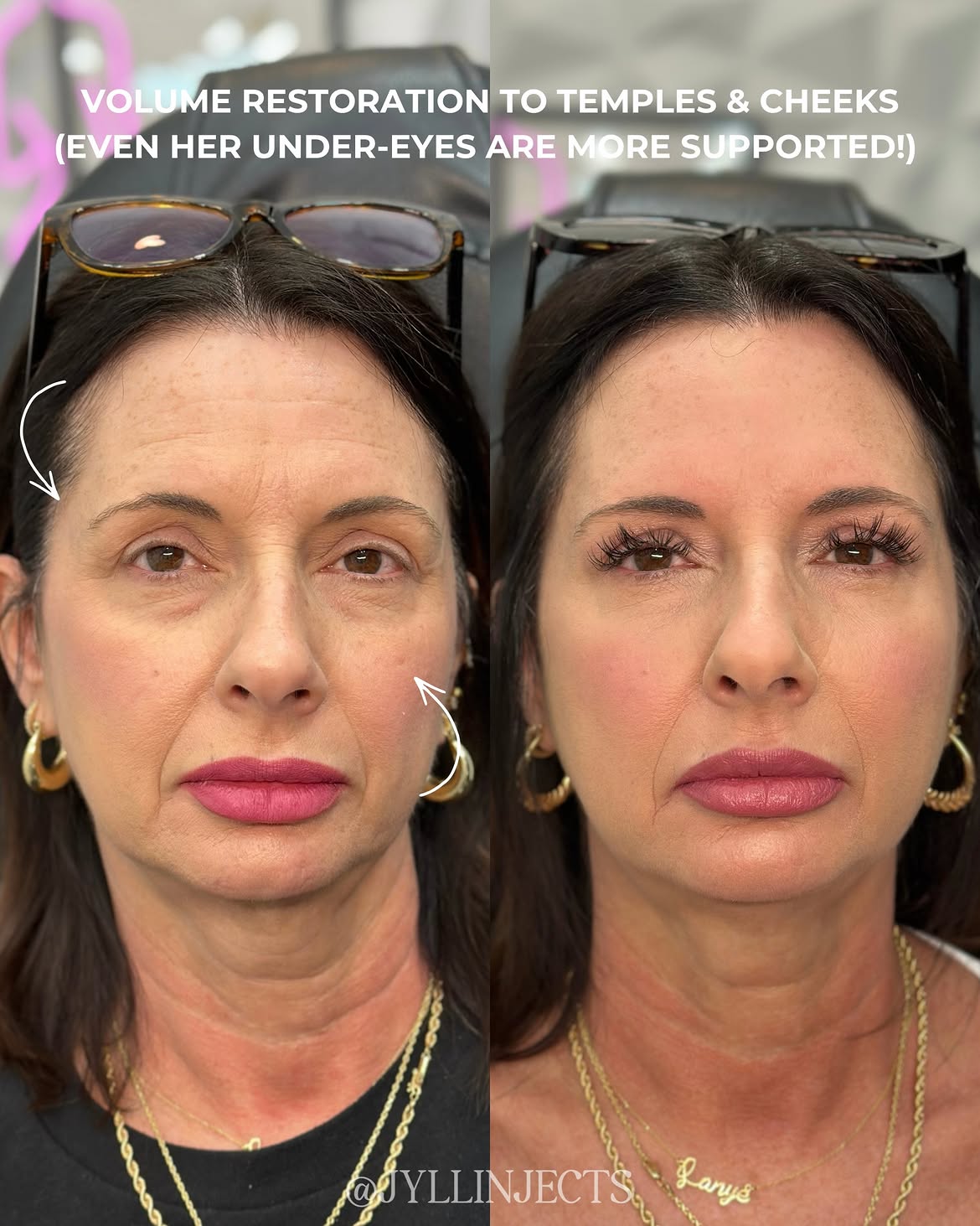Sculptra for Smile Lines: Results, Timeline, and Cost