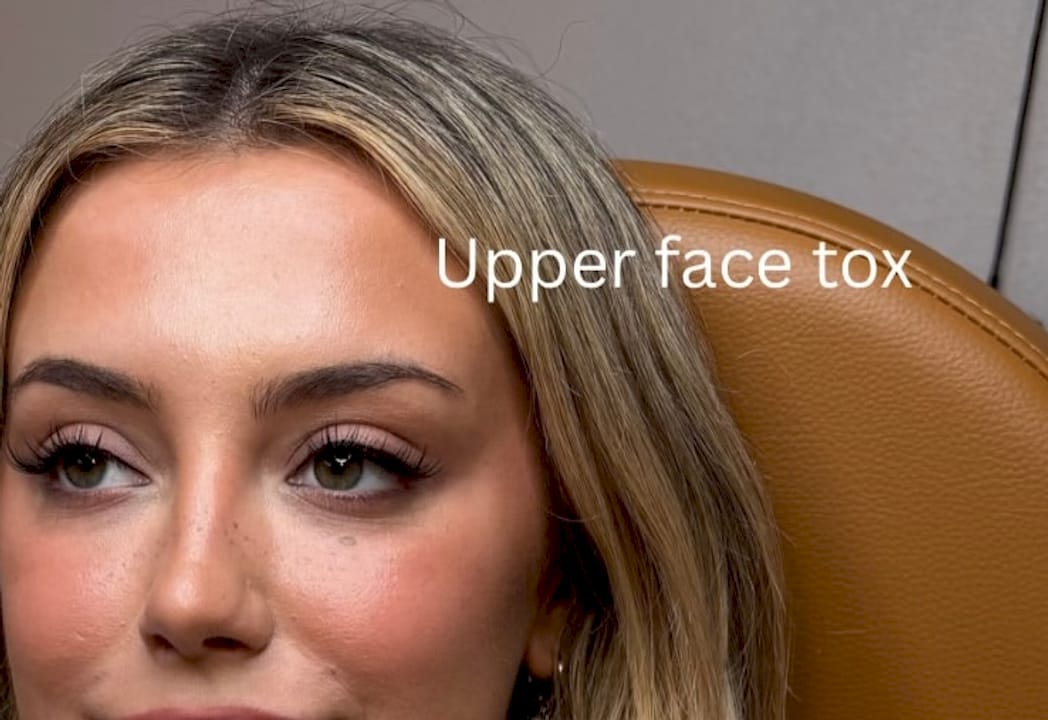 Dysport Units for Forehead: Typical Ranges Explained