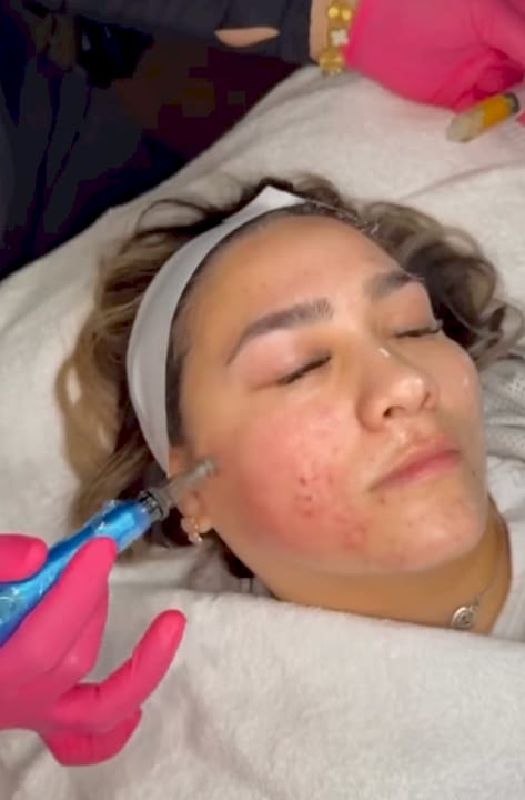 Microneedling Cost in Austin: Prices, Packages & Booking