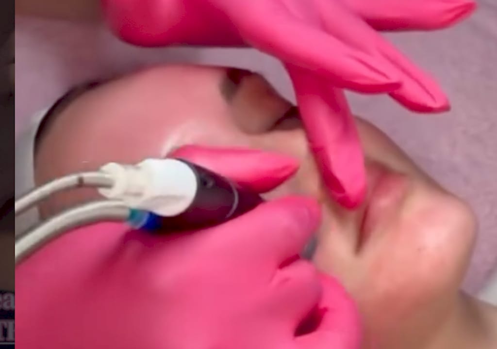 Microneedling Under Eyes: What Works for Circles & Lines