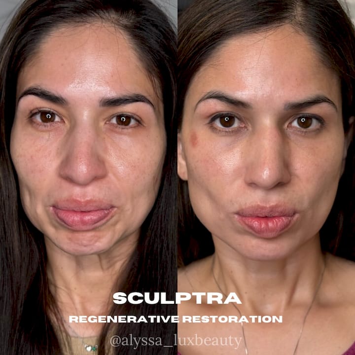Sculptra Cost in Austin: Vials, Sessions & What to Budget