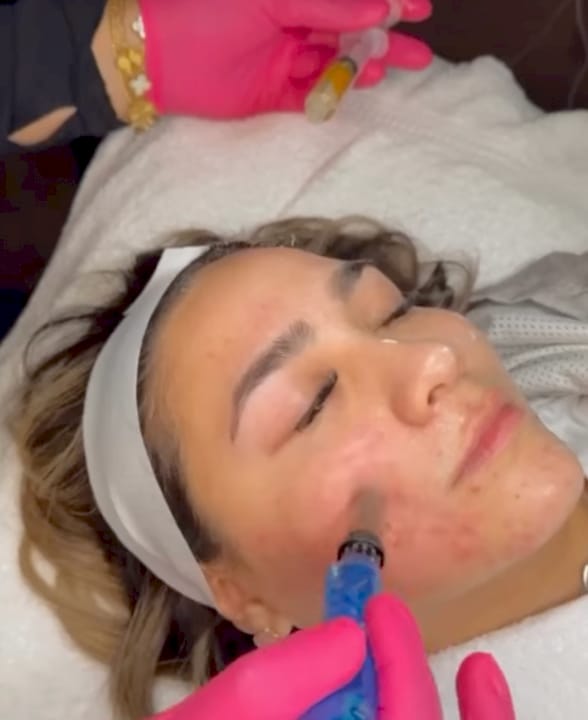 RF Microneedling for Neck Tightening: Does It Really Work?