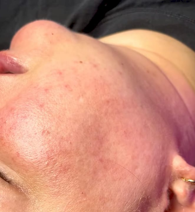Dermaplaning Aftercare: Your First 72 Hours Explained
