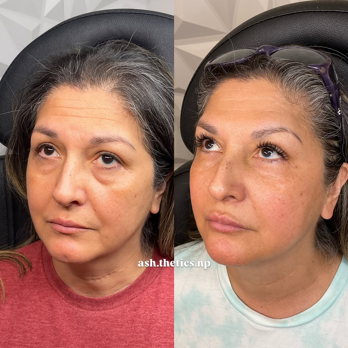 Your Lower Face Is Sagging at 37 and You've Done Everything Right: When More Filler Is the Wrong Answer