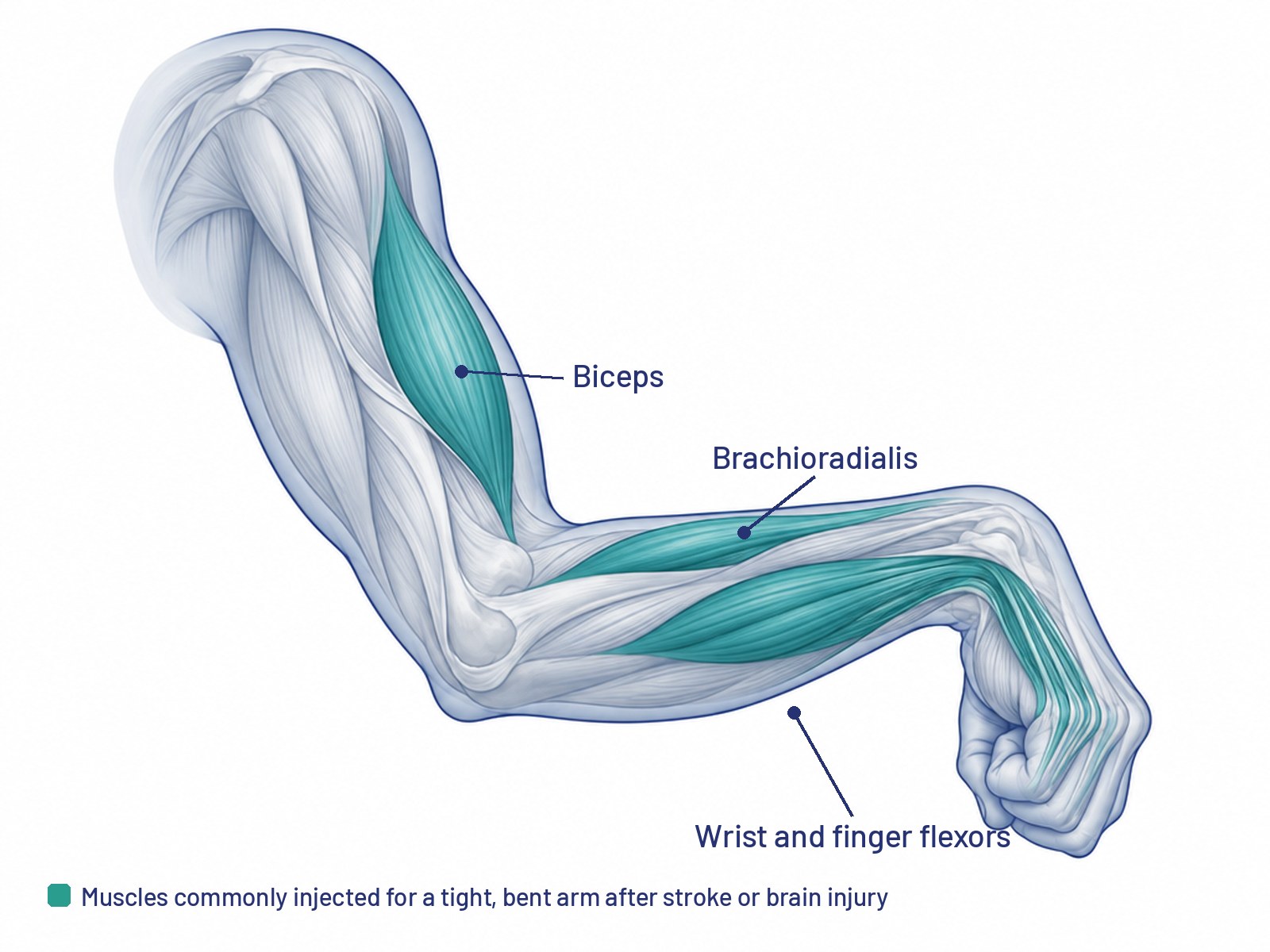 Illustration of an arm with spasticity: elbow bent, wrist and fingers curled, with the biceps, brachioradialis and wrist and finger flexor muscles highlighted as common injection targets
