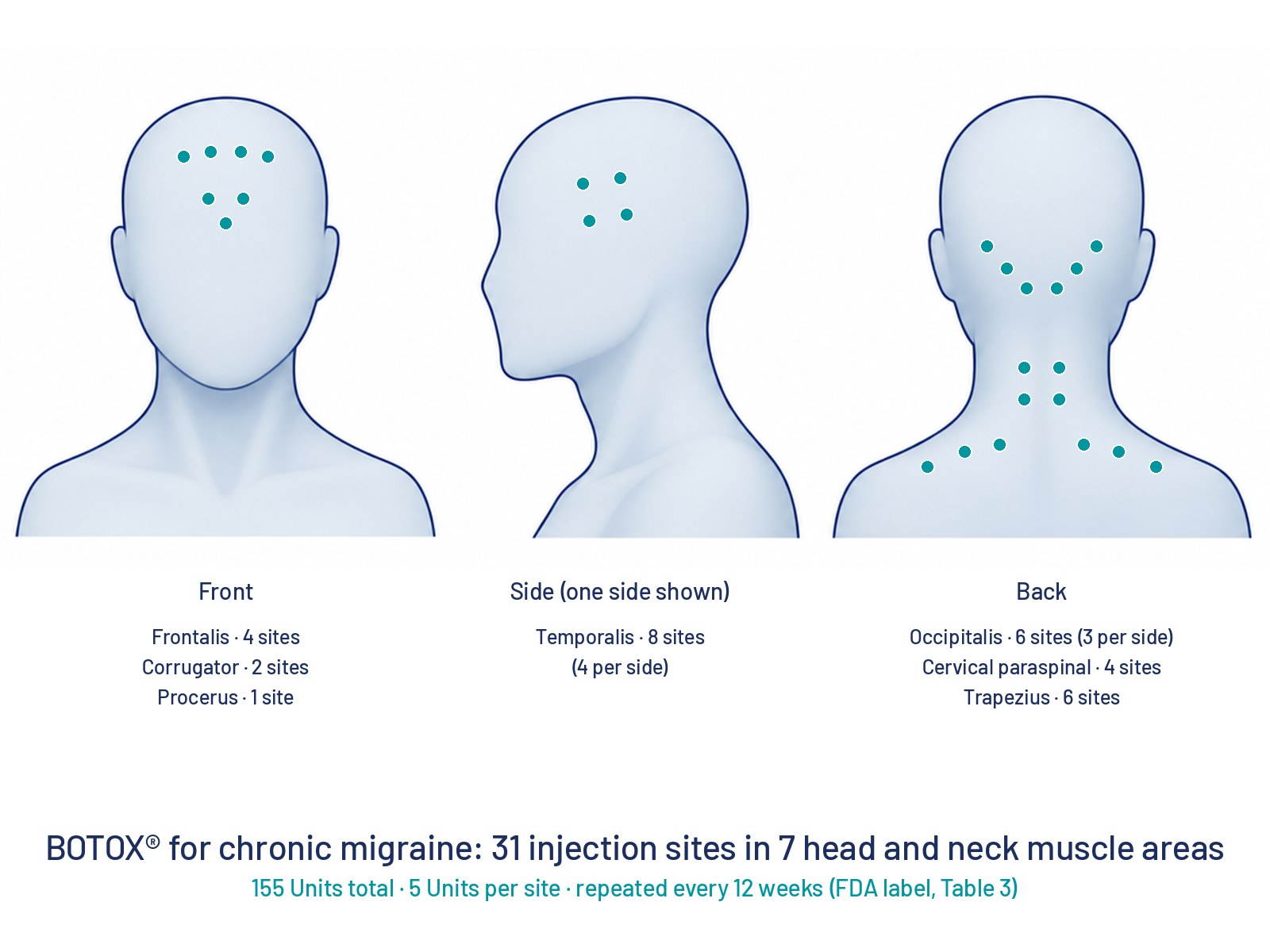 Simplified faceless head silhouettes from the front, side and back with teal dots marking the 31 FDA-label injection sites for chronic migraine