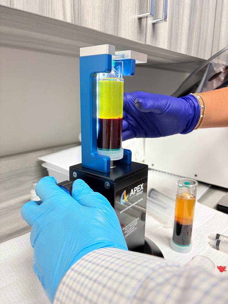 Blood separated into layers in the XCELL PRP system after centrifuging
