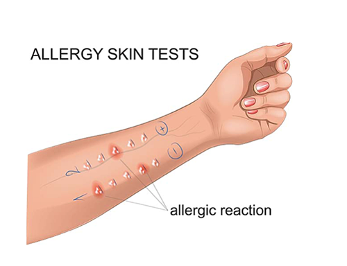 what causes allergic reactions