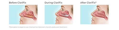 clarifix