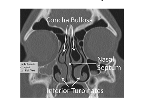 concha bullosa