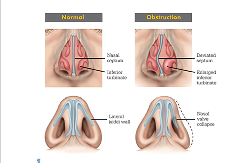 nasal congestion illustrated