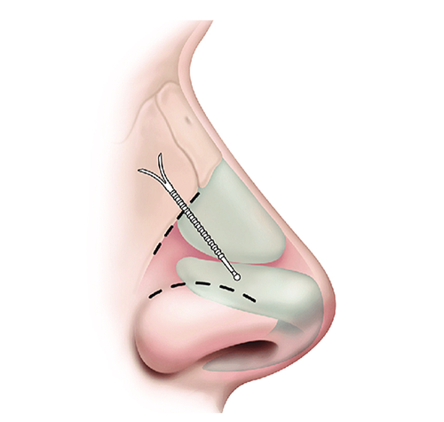 Latera nasal valve implant in office procedure