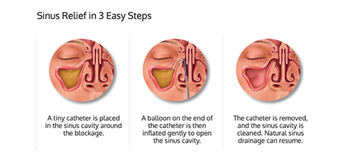 sinus relief