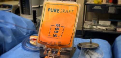 Can fat graft totally reconstruct a breast?