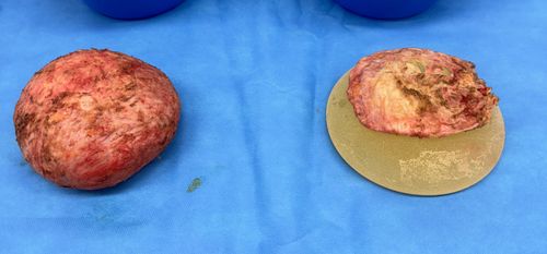 2 minute reads: does explant surgery hurt?