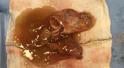 Do you need an MRI if you're thinking about an explant?