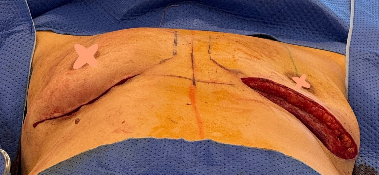 Explant surgery for ladies with small natural breasts - it ain't easy!