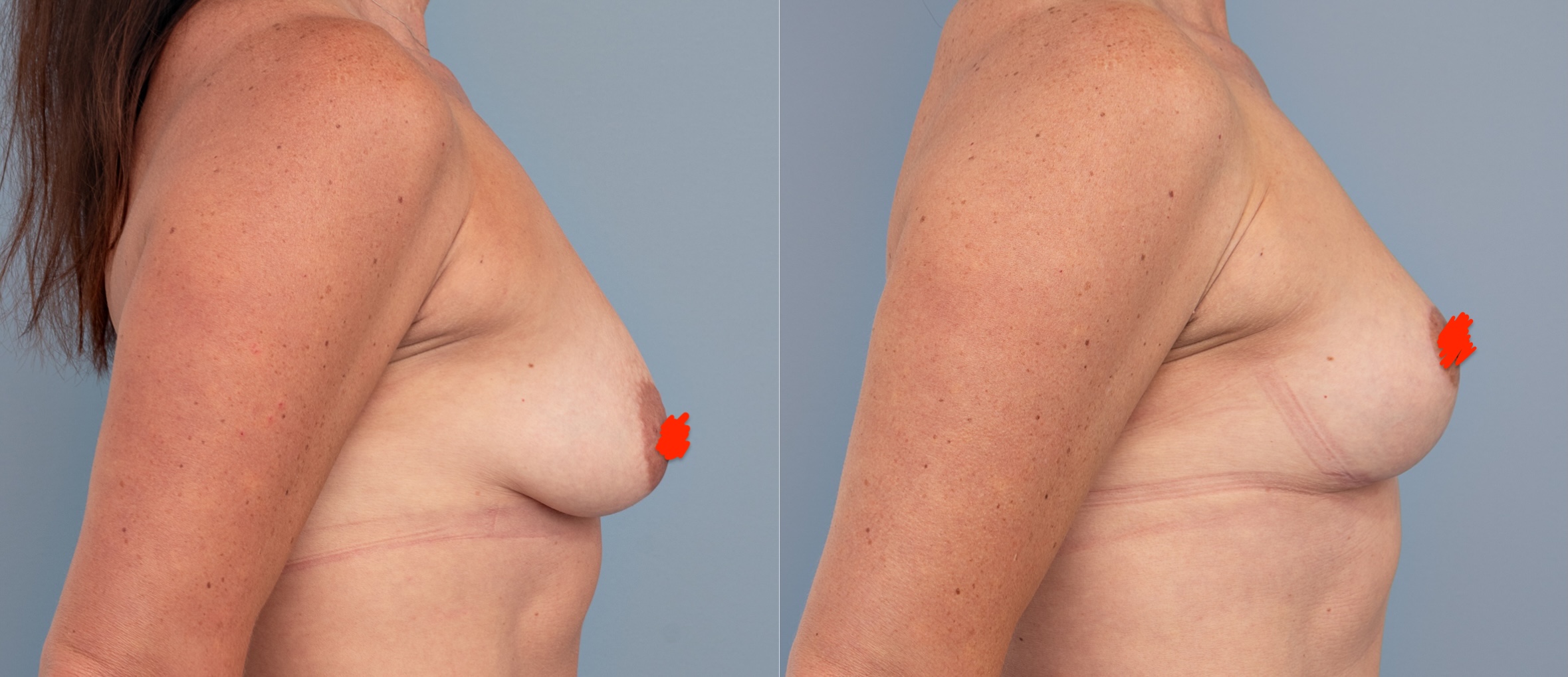 "Auto-augmentation" mastopexy: sounds cute, but is it real (or just for the reels)?
