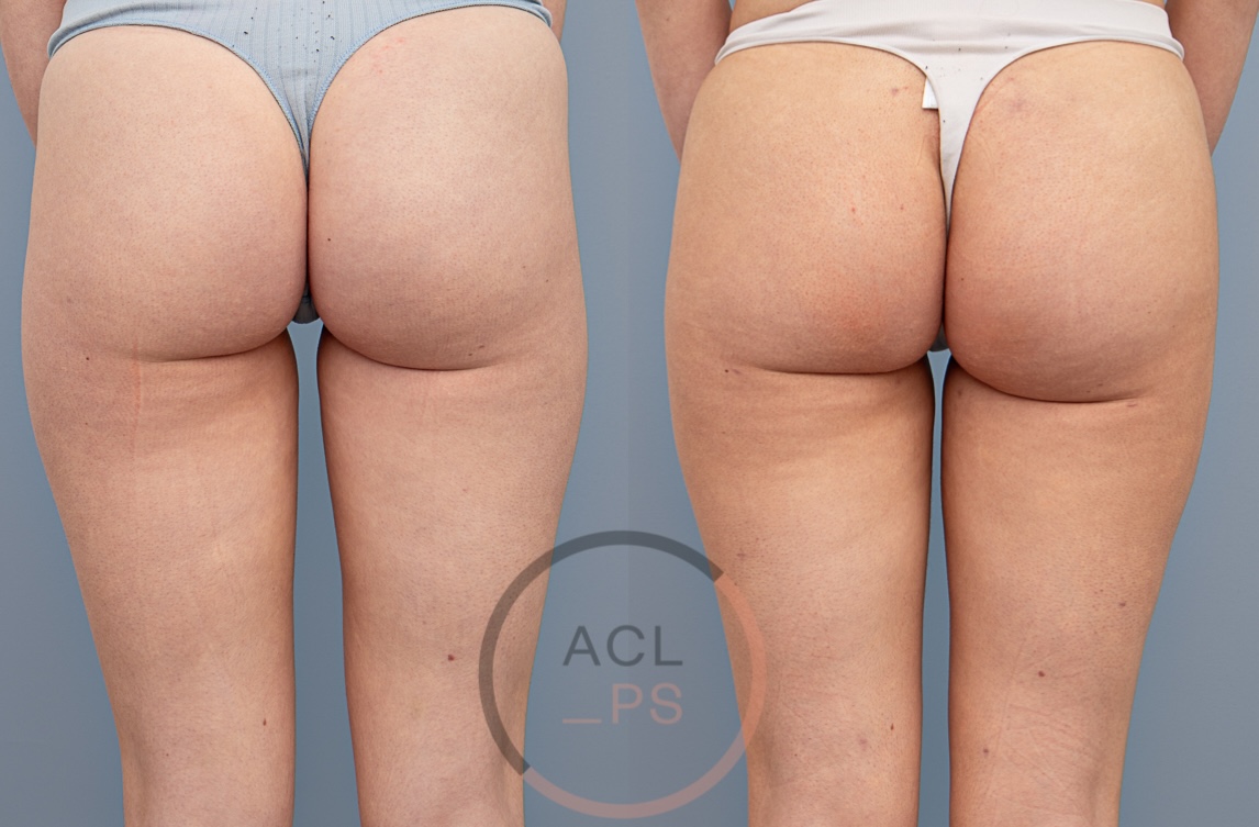 Am I a candidate for fat transfer to the breast?