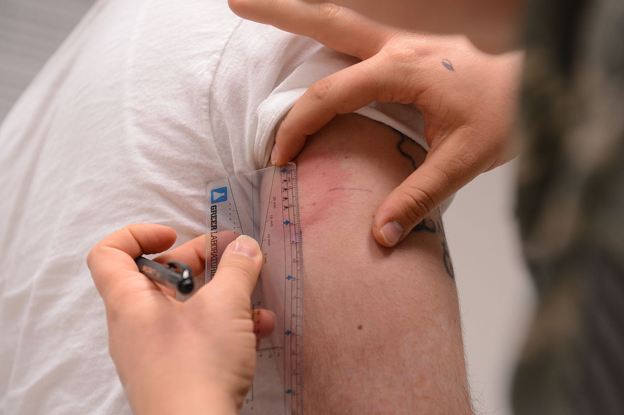 allergy shot reaction