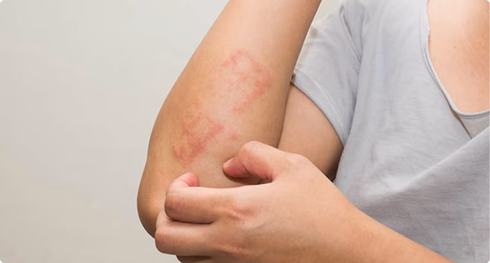 Eczema patient with a flare up on their arm