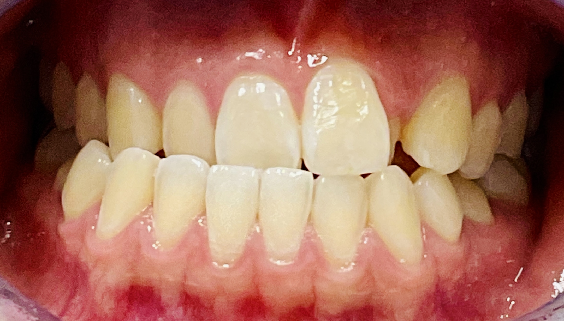 before and after treatment