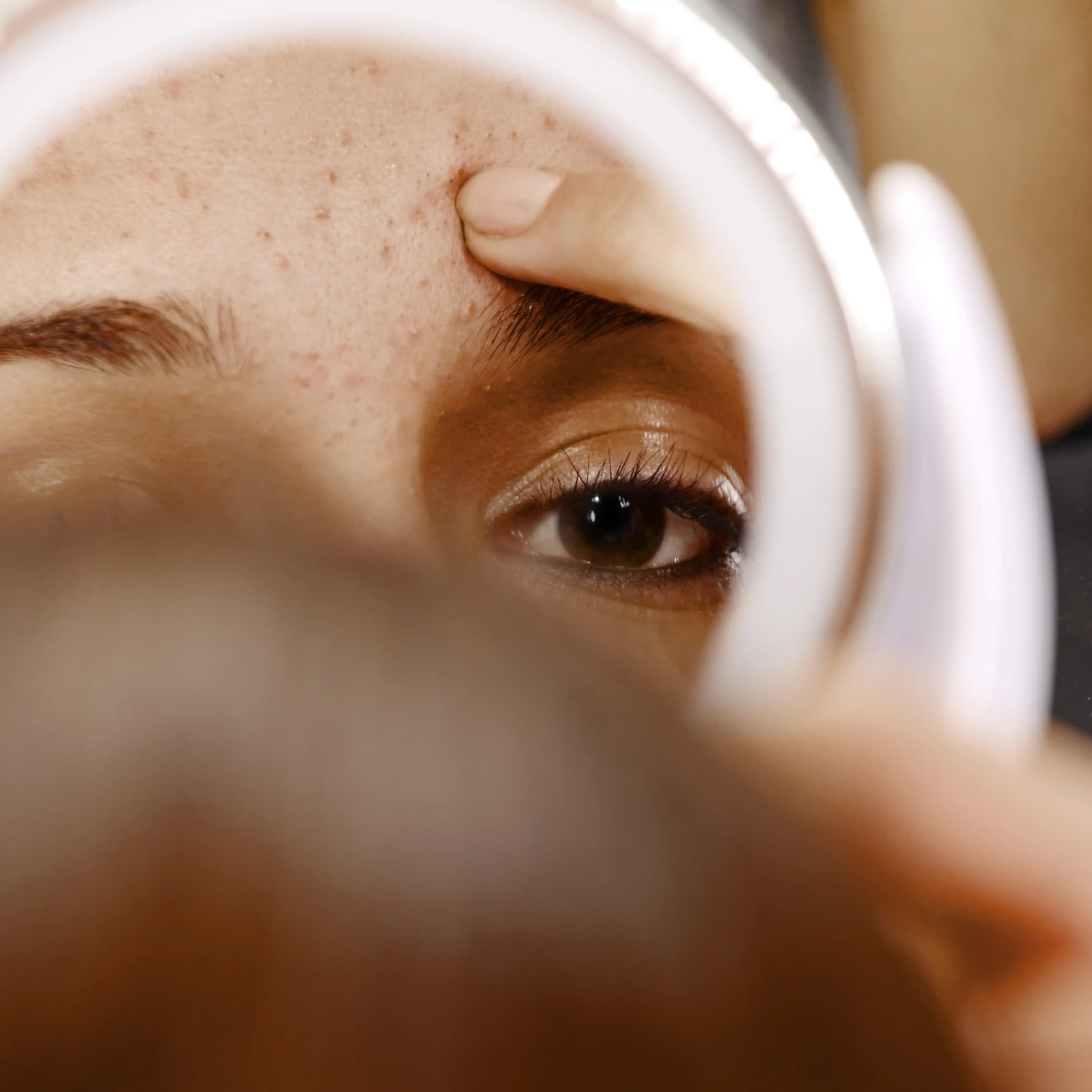 Skin purging vs. acne: How to tell the difference