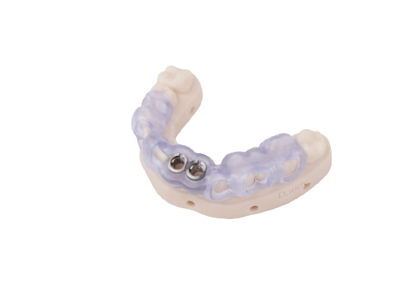 Prothèse Partielle Métallique