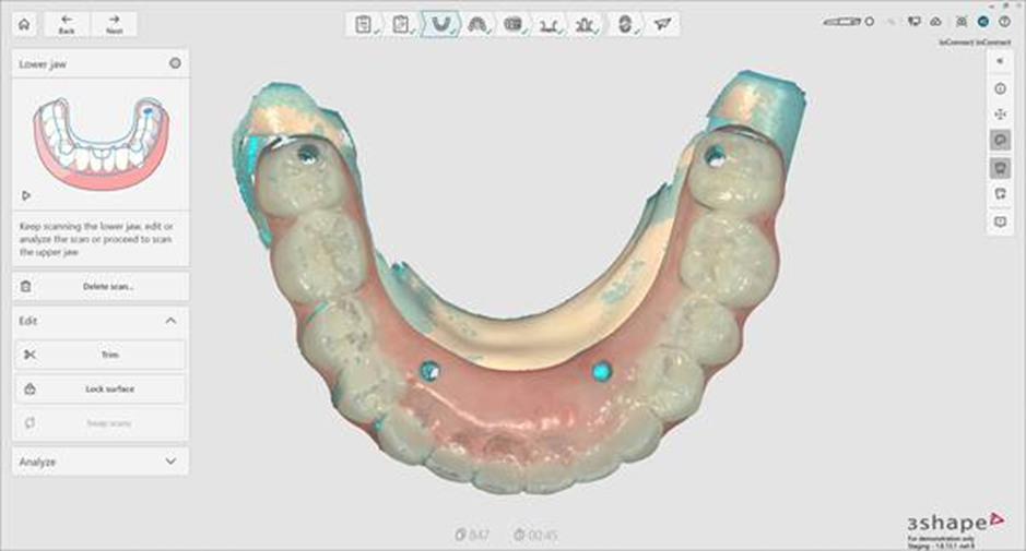 Étape 3 — Scan du provisoire mandibulaire