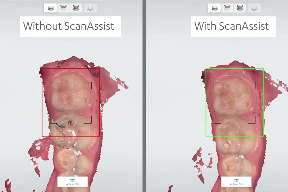 Comparatif scanner intra-oral 3D : sans ScanAssist (à gauche) avec désalignement, avec ScanAssist (à droite) scan mieux aligné et stabilisé.