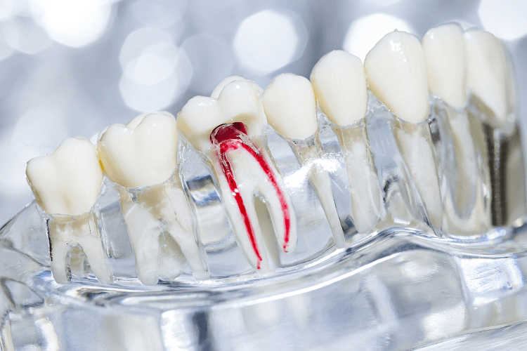 endodoncja-leczenie-zebow-bez-bolu