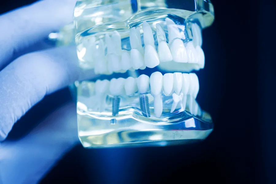 proteza-implant-korona-protetyczna-co-wybrac