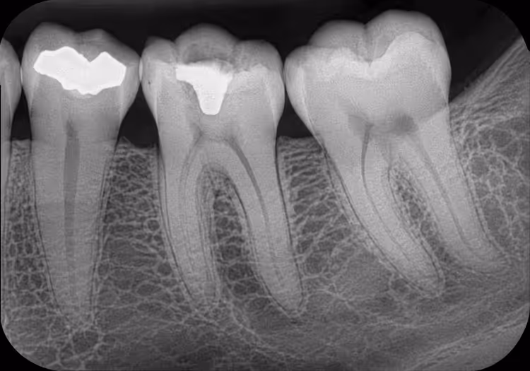 Zdjęcie RTG zębów trzonowych wykonane podczas diagnostyki bólu zęba