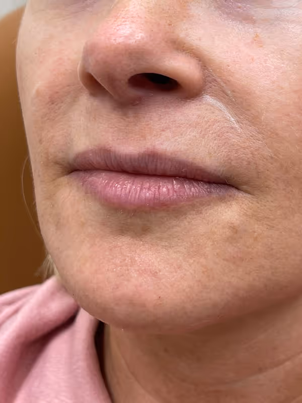 BRENNA_LIPS_RESTYLANE_REFYNE