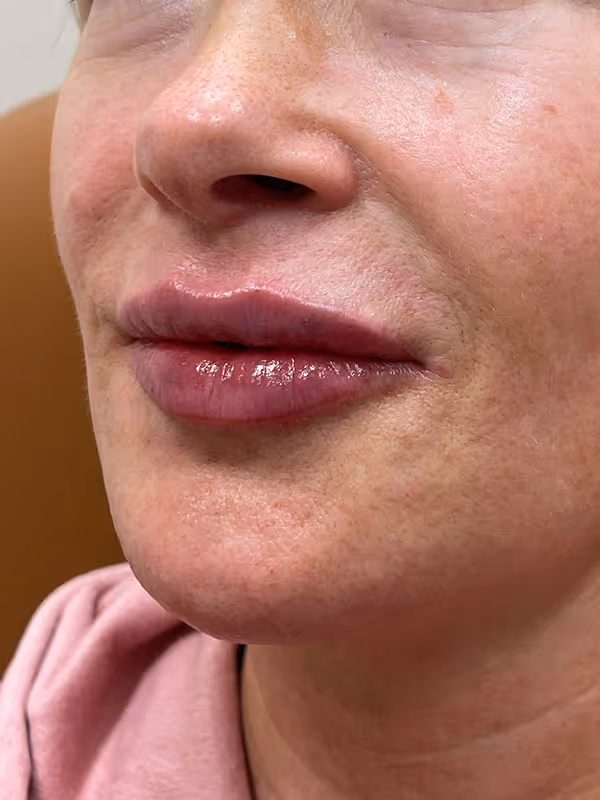 BRENNA_LIPS_RESTYLANE_REFYNE