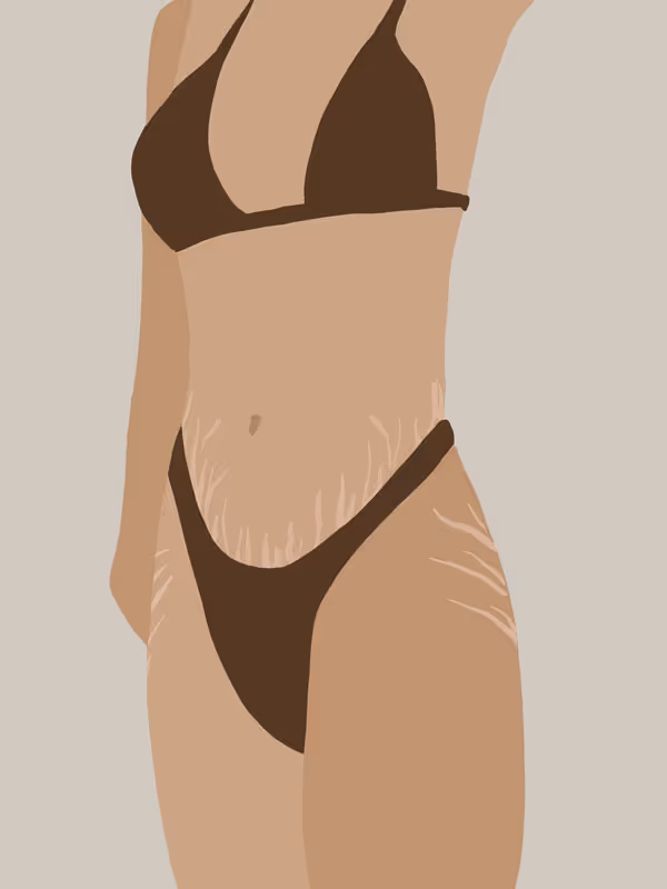 Stretch Marks
